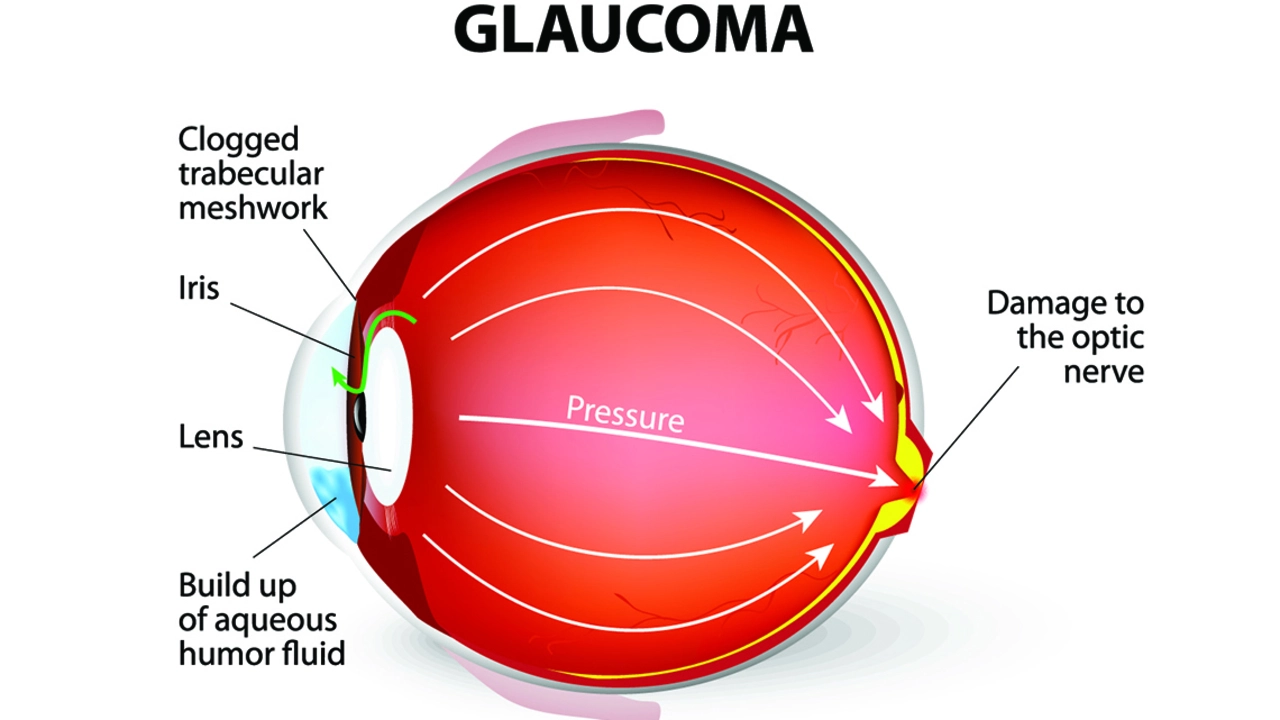 Enclomiphene and Glaucoma: Is There a Connection?